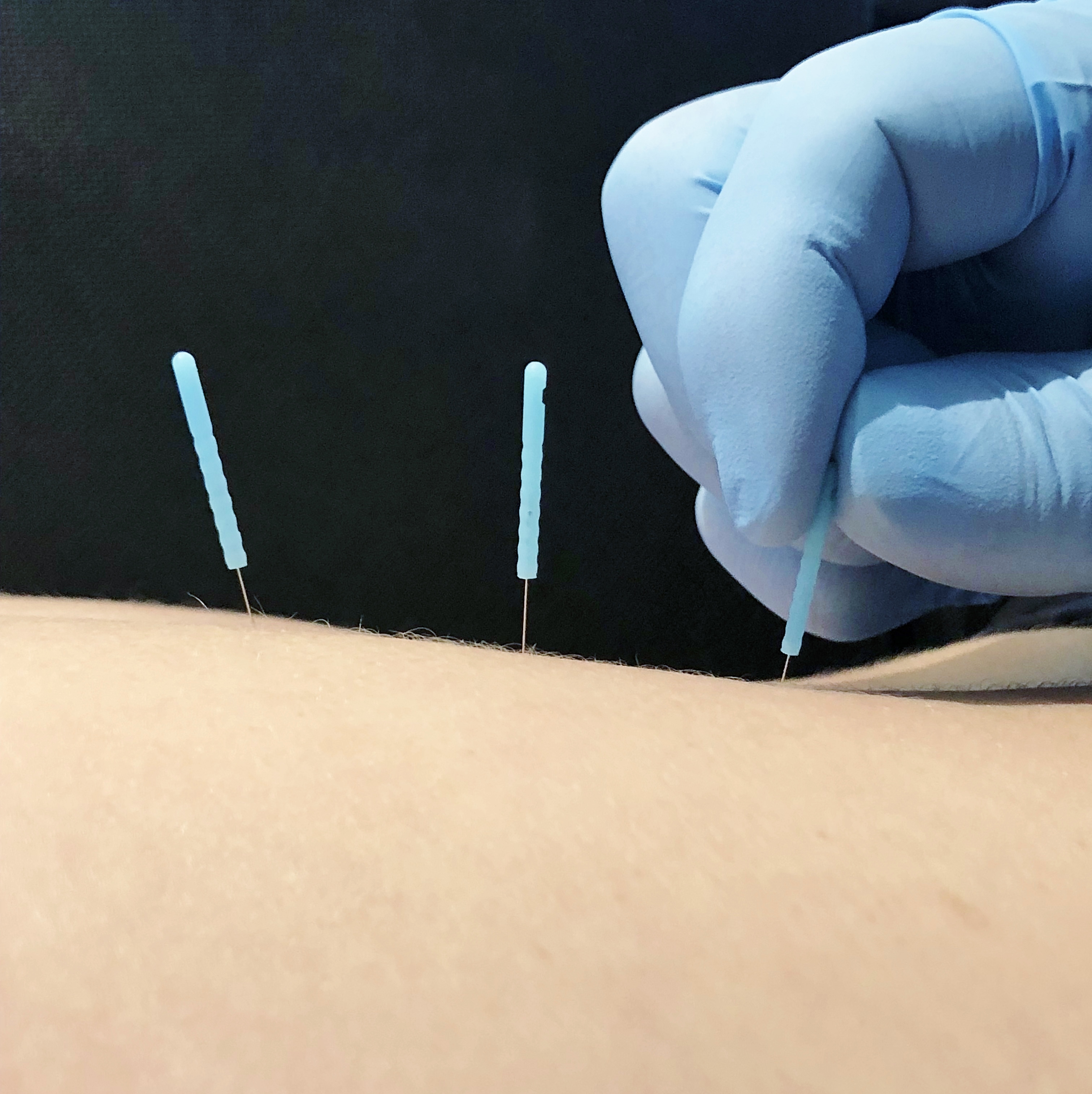 Dry Needling physical therapy